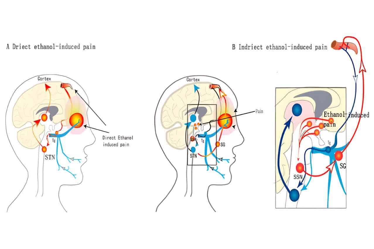 How Drinking Beer Causes Headaches